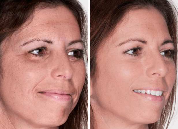 Before & After