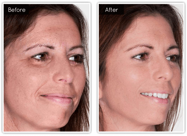 Before & After