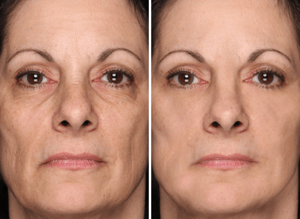 Before & After