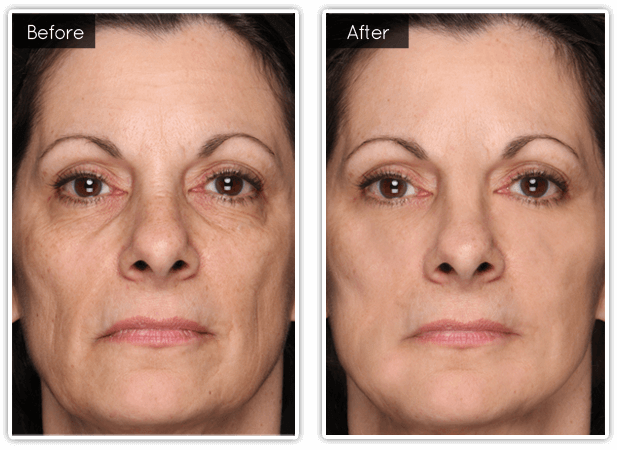 Before & After