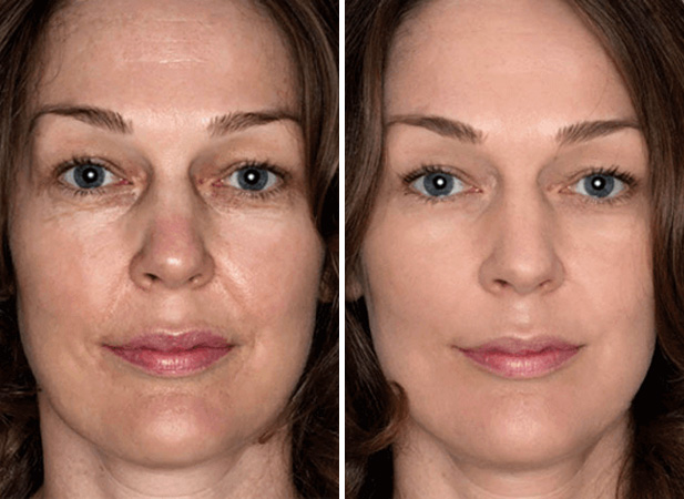 Before & After