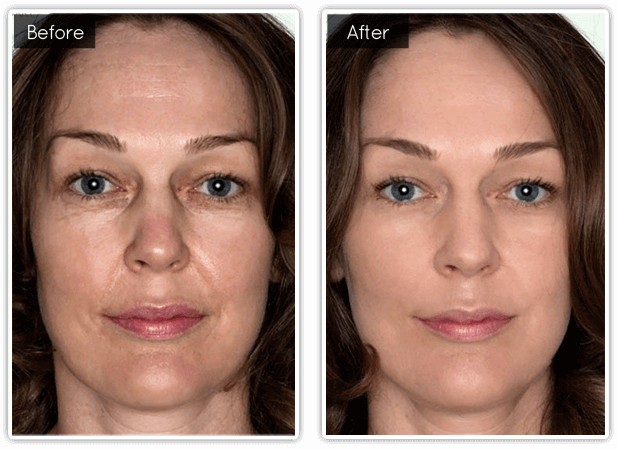 Before & After